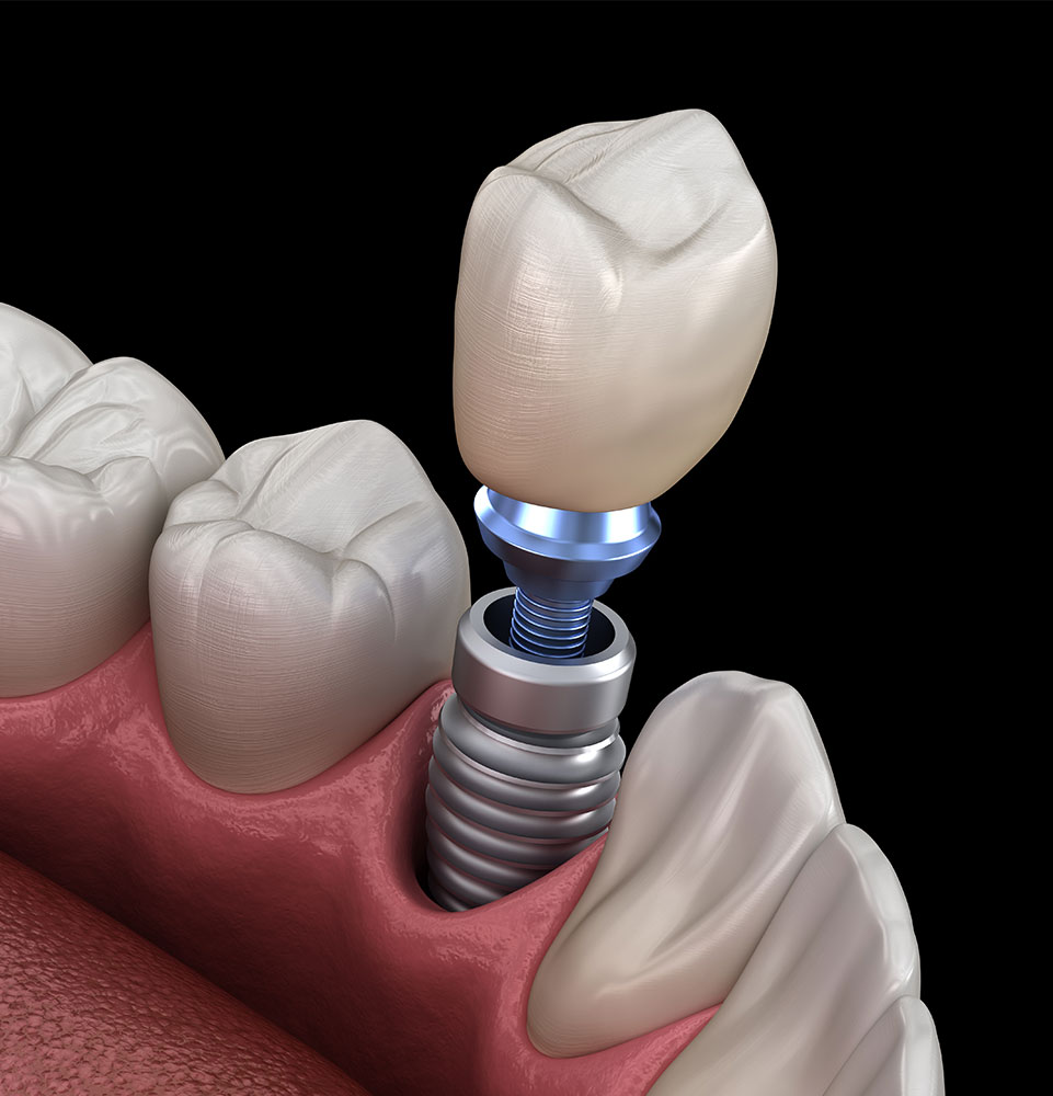 dental implant 3d