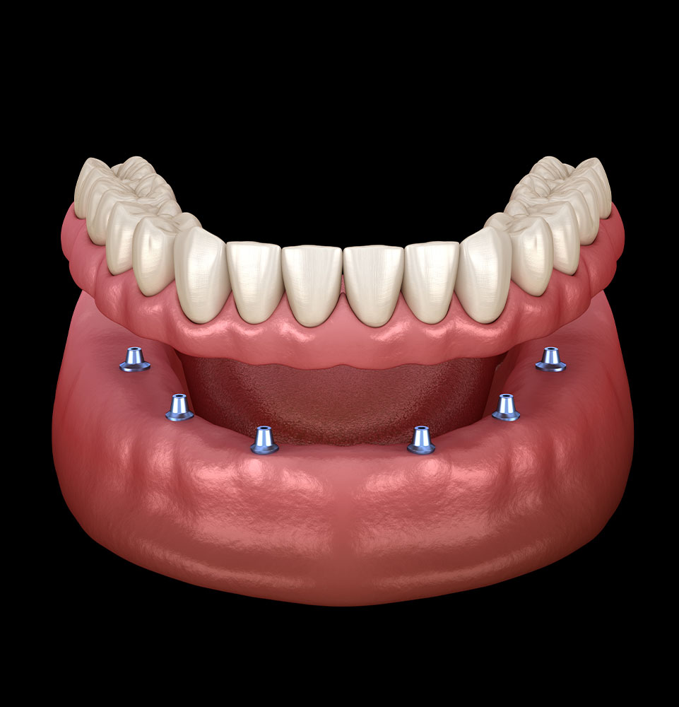 implant supported denture 3d