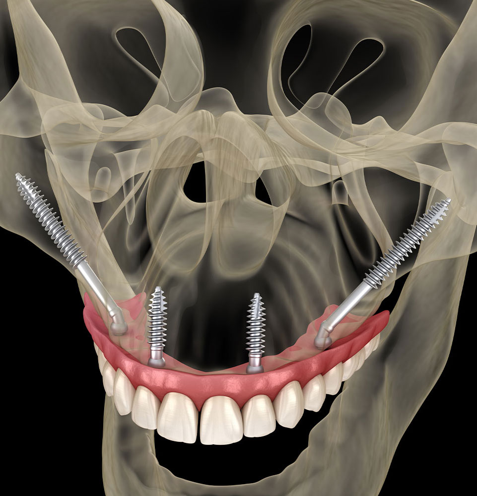 zygomatic dental implant 3d