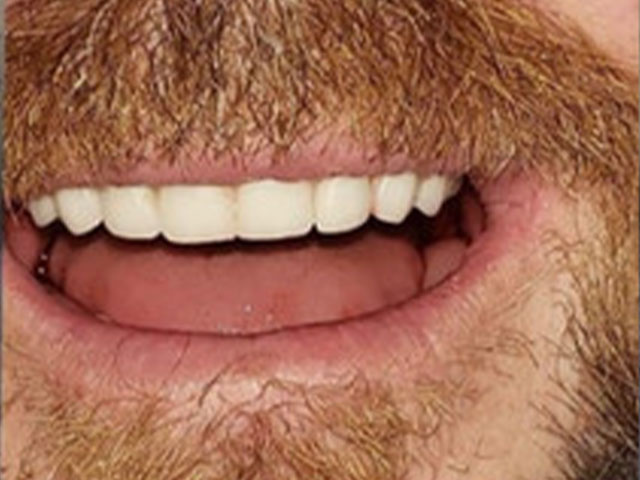 case 1 dental implants after