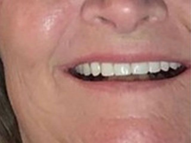 case 2 dental implants after