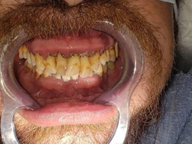 case 1 dental implants before