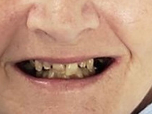 case 2 dental implants before