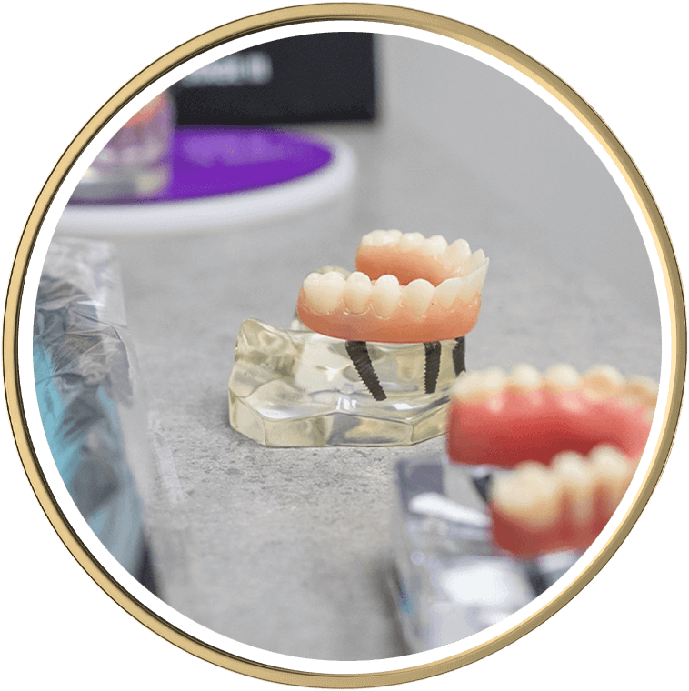 full mouth implant model
