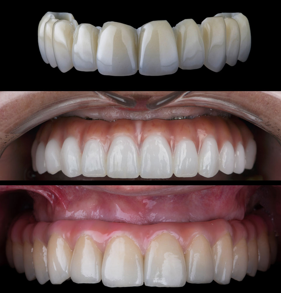fp1, fp2, fp3 dental implants